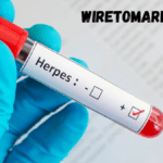 hsv 1 igg type specific ab