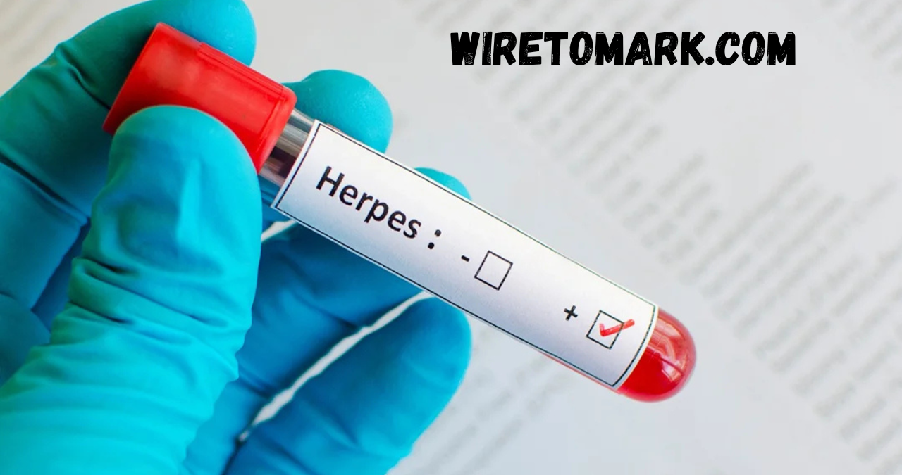 hsv 1 igg type specific ab